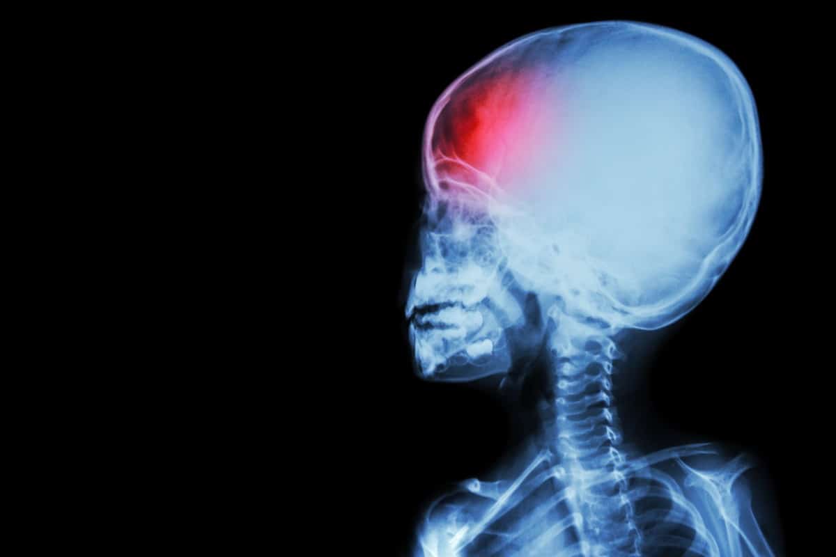 What Are The Causes Of Infant Brain Injuries? - Harris Lowry Manton LLP